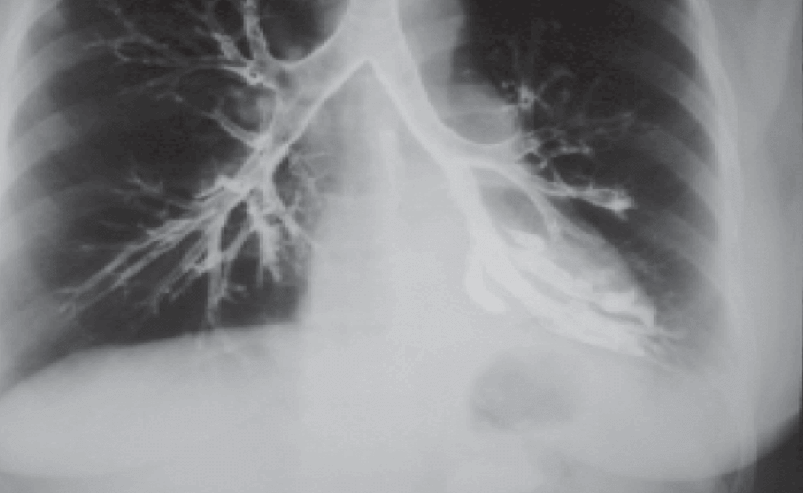 Bronquiectasia