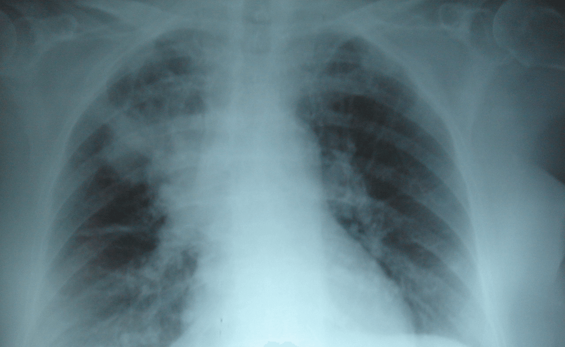 Kinesiología Respiratoria